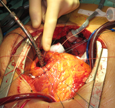CarbonAid® in use during open heart surgery