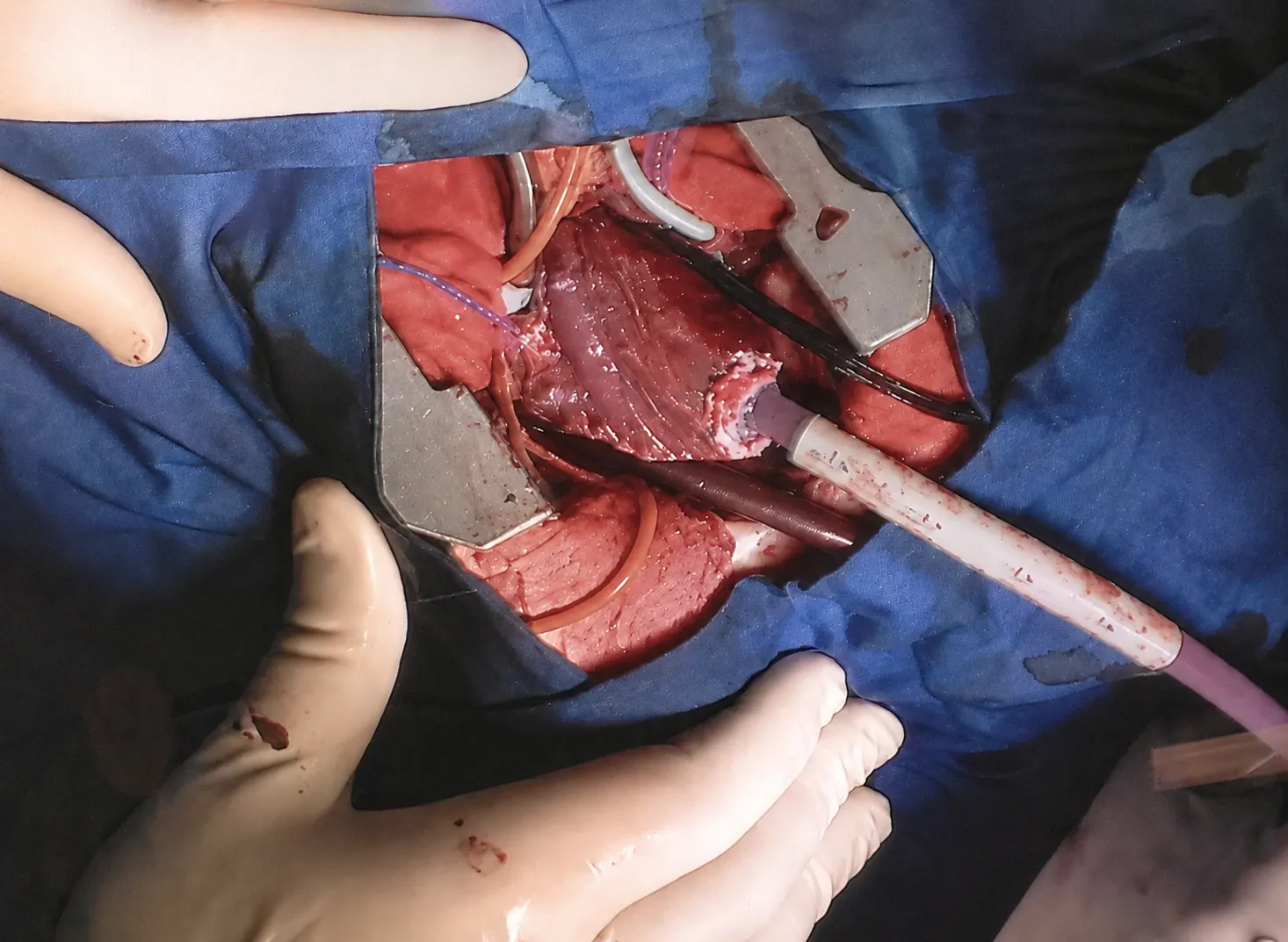 CarbonMini® in use during minimally invasive cardiac surgery