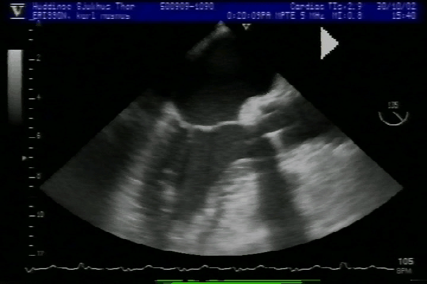 Transesophageal echocardiography (TEE), midesophageal long-axis view with CO₂ delivered via CarbonAid®.