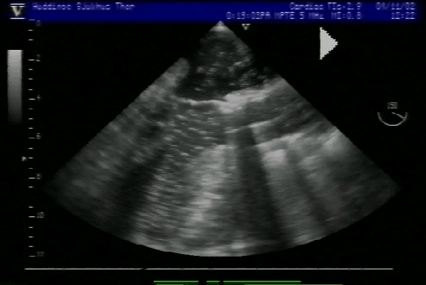 Transesophageal echocardiography (TEE), midesophageal long-axis view without CO₂ insufflation.